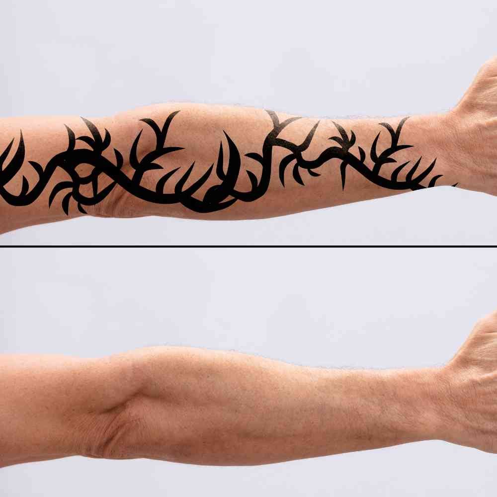 tattoo removal in kolkata