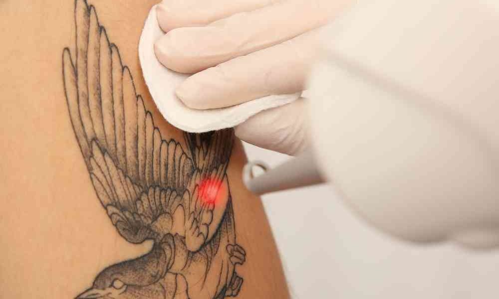 lessor tattoo removal process