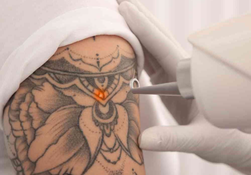 tattoo removal with lessor machine,